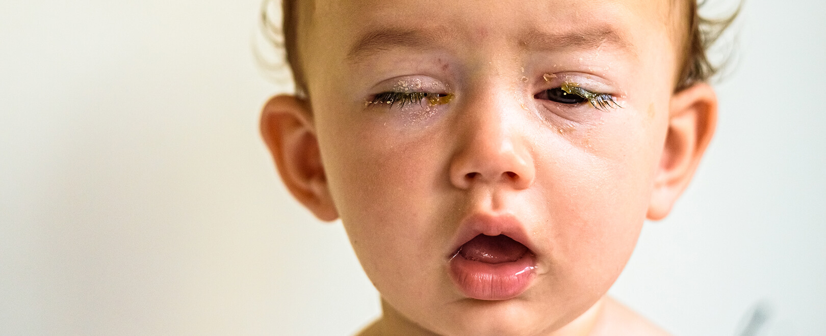 Konjuktivitis kod beba i dece | Femibion